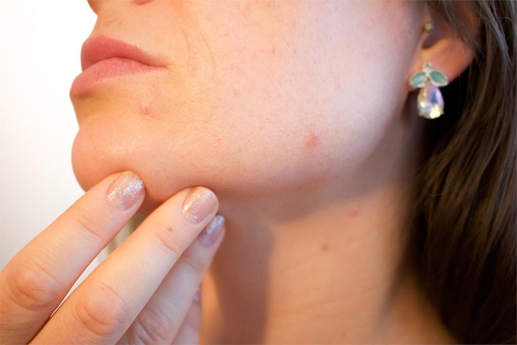 Consejos para cuidar la piel y prevenir el acné
