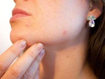 Consejos para cuidar la piel y prevenir el acné