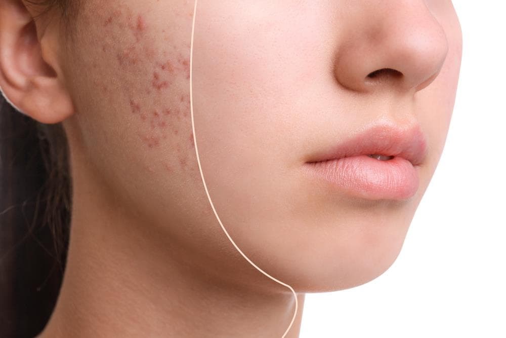 ¿Qué tratamientos faciales son más eficaces para combatir el acné? 